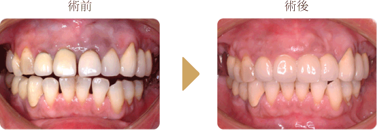 上顎前歯部埋入症例