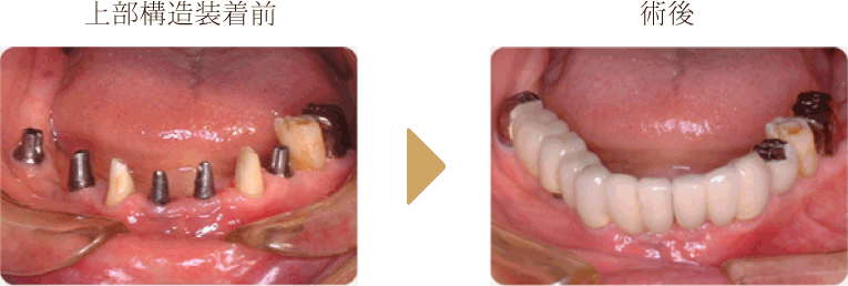上顎前歯部埋入症例