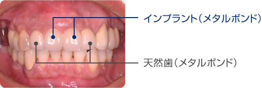 上顎前歯部埋入症例長