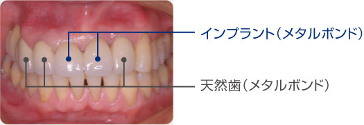 上顎前歯部埋入症例長