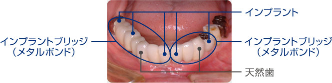 下顎前歯部埋入症例長